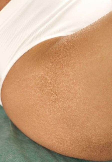 When do stretch marks appear?